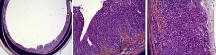 Score 3: Severe inflammatory lesions. Lymphocytes and plasmocytes invasion inducing thickening all around the trachea wall. Score 3: Severe inflammatory lesions. Lymphocytes and plasmocytes invasion inducing thickening all around the trachea wall.